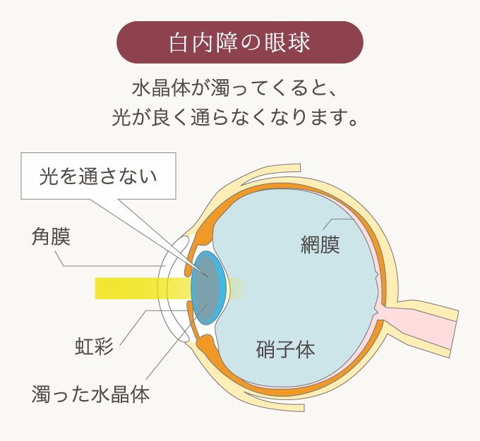 白内障の眼球