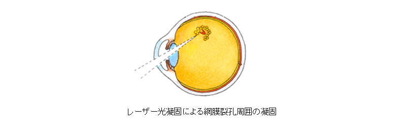 診療内容 -裂孔原性網膜剥離-｜札幌 桑園 おくしば眼科